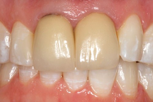 cerec3