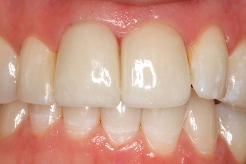 cerec4