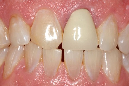 cerec5