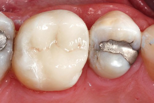 cerec9